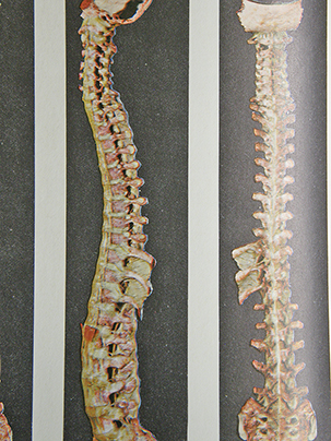 Visione di insieme della colonna vertebrale vista lateralmente ed in antero-posteriore