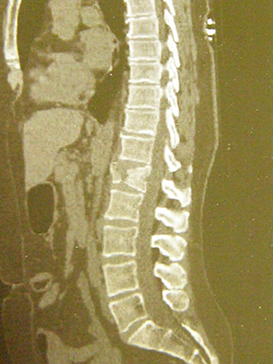 Frattura osteoporotica di L1 - clicca per ingrandire