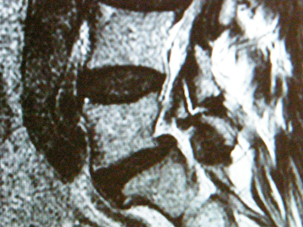 Chirurgia vertebro-midollare: spondilolistesi e spondilolisi