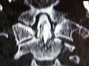 TAC post-operatoria con visione in antero-posteriore - clicca per ingrandire