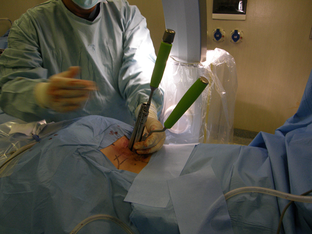 Chirurgia robotica - inserimento barra