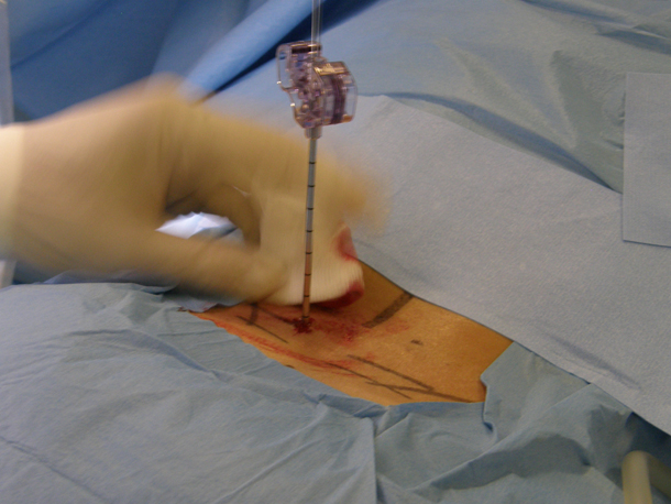 Chirurgia robotica - inserimento del filo guida all'interno del trocar