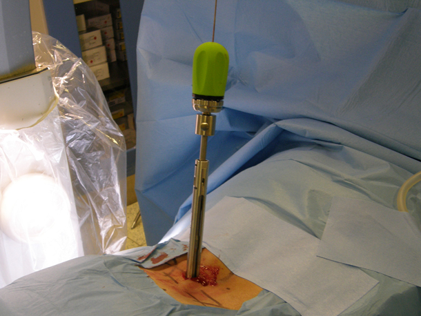Chirurgia robotica - inserimento vite nella vertebra